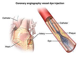 Anterior view of fatty heart with catheter inserted into the coronary artery and atherosclerosis vessel inset with catheter releasing dye for angiography.