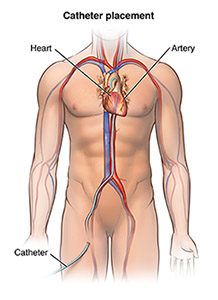 Anterior view of male figure with femoral artery catheter insertion.