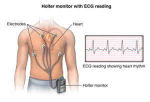 Anterior view male figure torso with holter monitor and ecg/heart rhythm inset