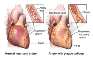 Front view of the heart with comparing a healthy artery vs. an artery with plaque buildup.